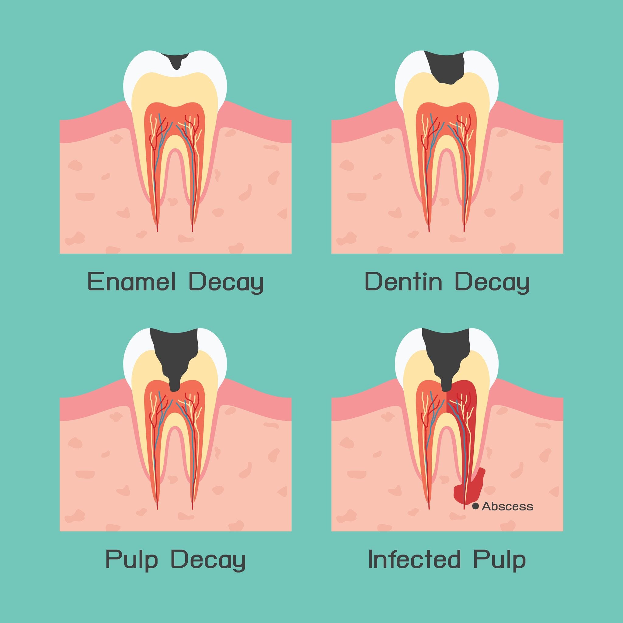 21045454 - tooth decay