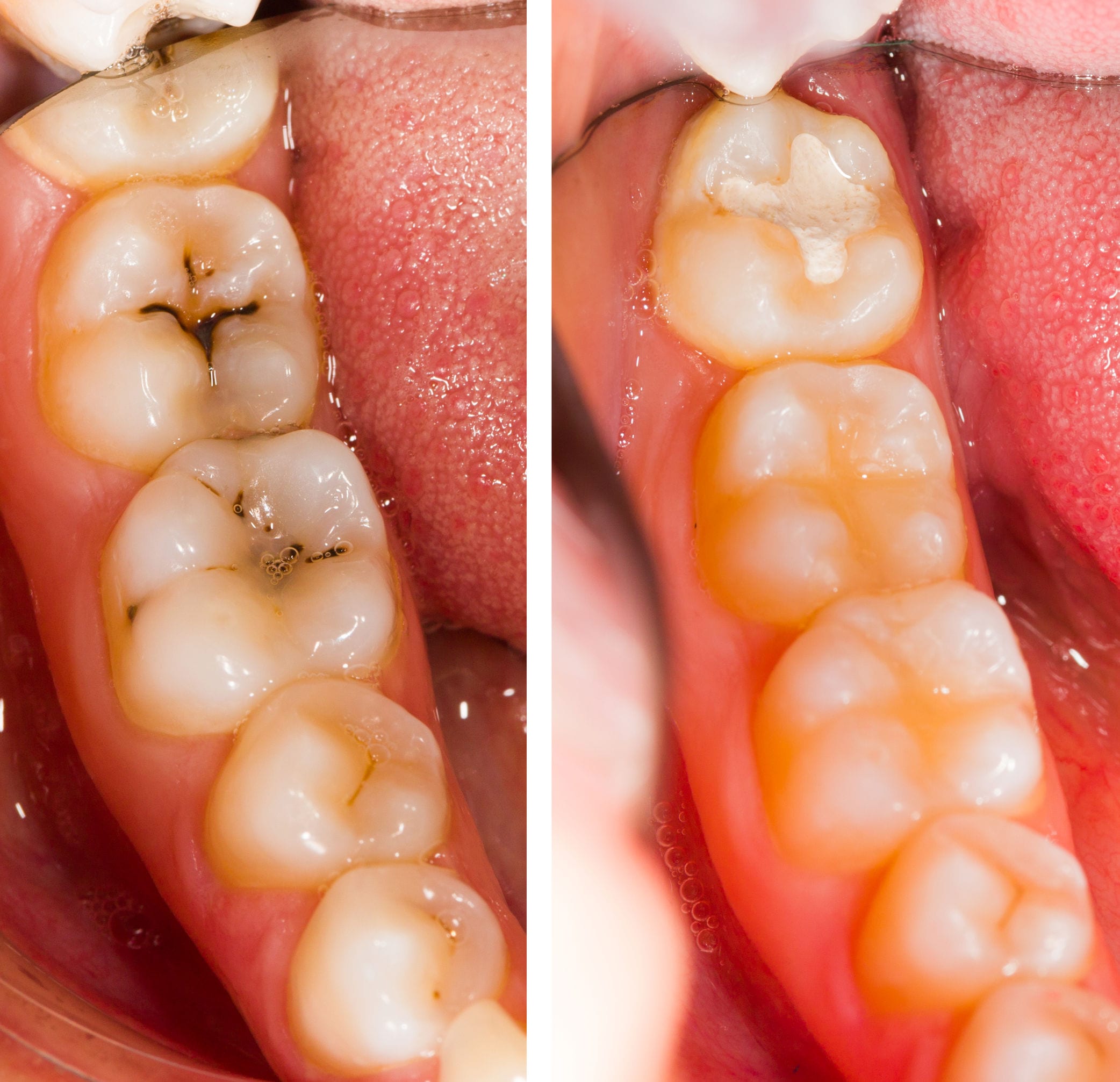 33275878 - before and after dental treatment - beforeafter series.